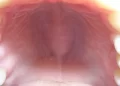 Causes  & Treatments for a Bump on the Roof of the Mouth