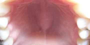 Causes  & Treatments for a Bump on the Roof of the Mouth