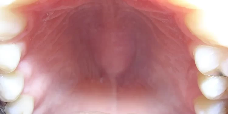 Causes  & Treatments for a Bump on the Roof of the Mouth